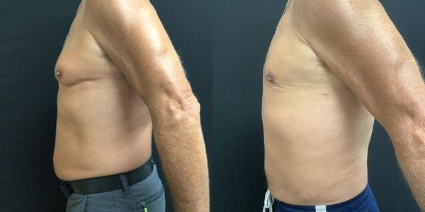 Abdominal Sculpting (6-pack) Before and After Patient 153 (2)