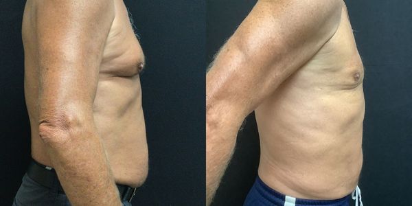 Abdominal Sculpting (6-pack) Before and After Patient 153 (3)