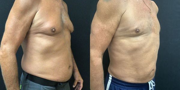 Abdominal Sculpting (6-pack) Before and After Patient 153 (4)