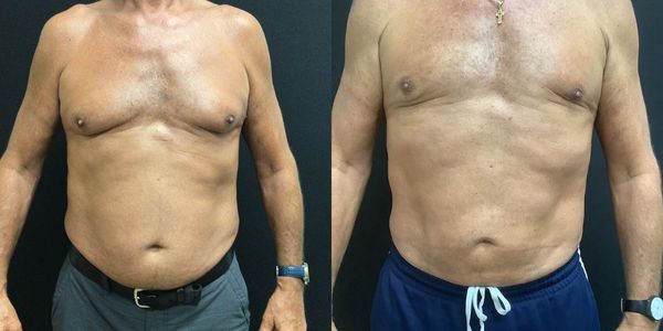 Abdominal Sculpting (6-pack) Before and After Patient 153 1