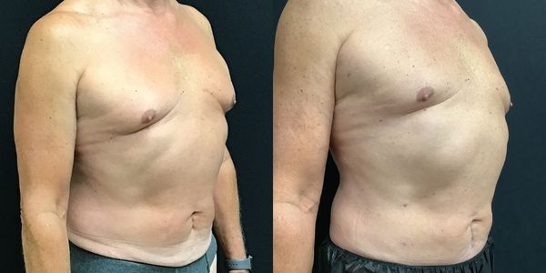 Abdominal Sculpting (6-pack) Before and After Patient 154 (2)