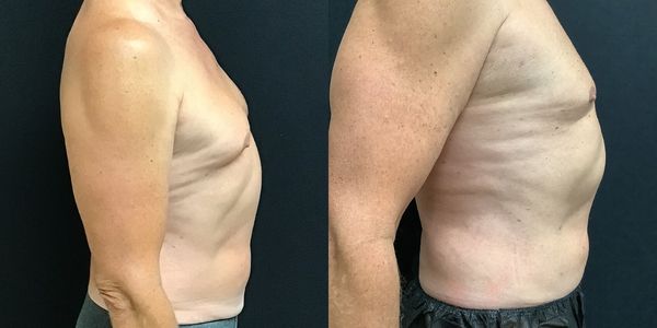 Abdominal Sculpting (6-pack) Before and After Patient 154 (3)