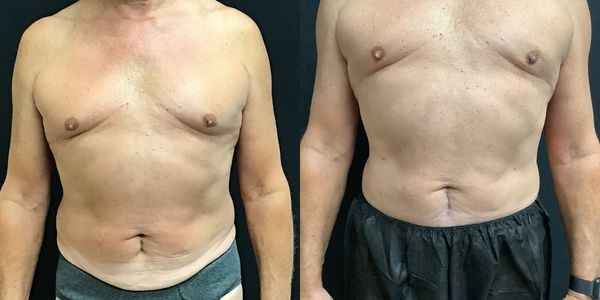Abdominal Sculpting (6-pack) Before and After Patient 154