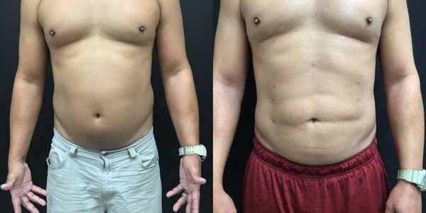 Abdominal Sculpting (6-pack) Before and After Patient 165