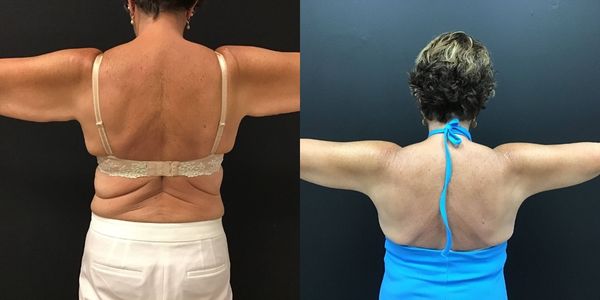 Arm Lift Before and After Patient 141 8