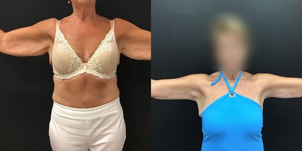 Arm Lift Before and After Patient 141 6