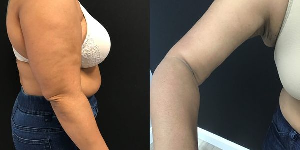 Arm Lift Before and After Patient 169 3