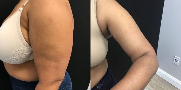 Arm Lift Before and After Patient 169 2