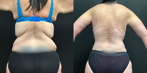 Arm Lift Before and After Patient 180 4