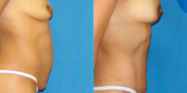 Breast Augmentation Before and After Patient 1 2