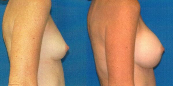 Breast Augmentation Before and After Patient 119 2