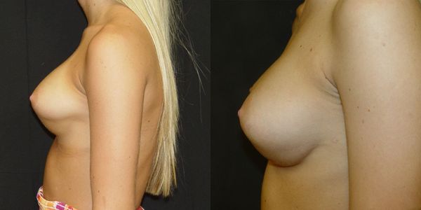 Breast Augmentation Before and After Patient 12 3