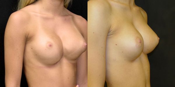 Breast Augmentation Before and After Patient 12 2
