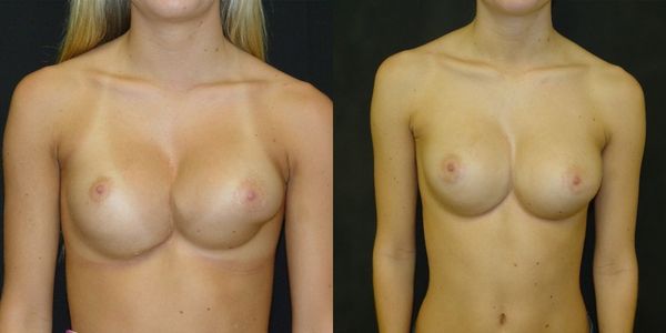 Breast Augmentation Before and After Patient 12 5