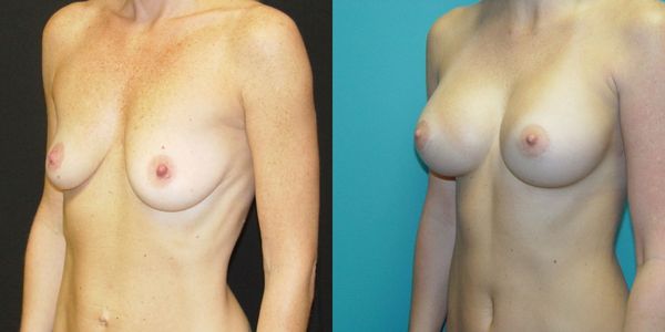 Breast Augmentation Before and After Patient 120 5