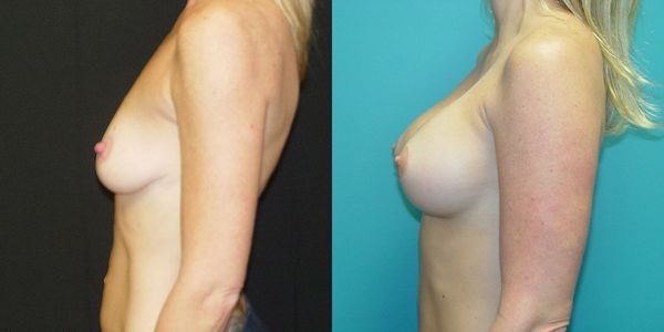 Breast Augmentation Before and After Patient 120 3