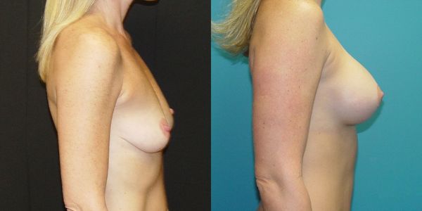 Breast Augmentation Before and After Patient 120 2