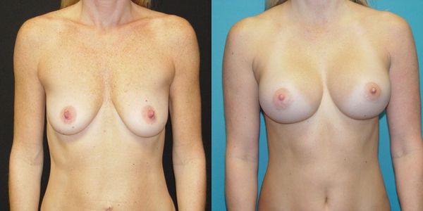 Breast Augmentation Before and After Patient 120