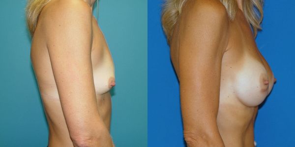 Breast Augmentation Before and After Patient 121 3