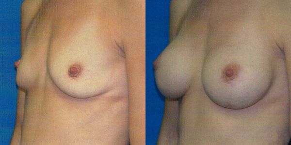 Breast Augmentation Before and After Patient 124