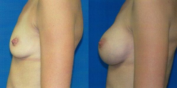 Breast Augmentation Before and After Patient 124 3