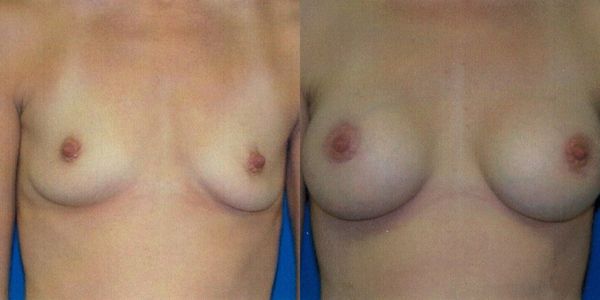 Breast Augmentation Before and After Patient 124 2