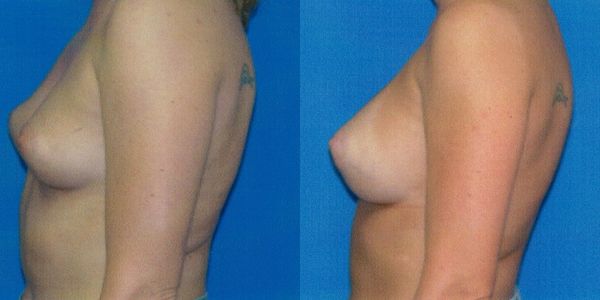 Breast Augmentation Before and After Patient 125