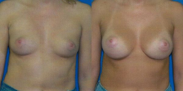 Breast Augmentation Before and After Patient 125 3