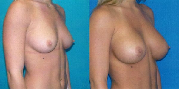Breast Augmentation Before and After Patient 126 2