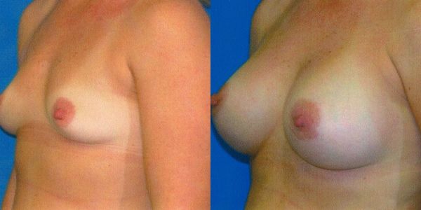 Breast Augmentation Before and After Patient 127 3