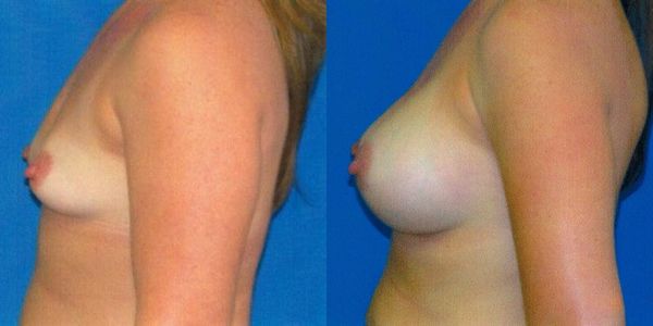 Breast Augmentation Before and After Patient 127 2