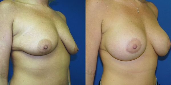 Breast Augmentation Before and After Patient 128