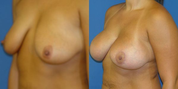 Breast Augmentation Before and After Patient 129 2