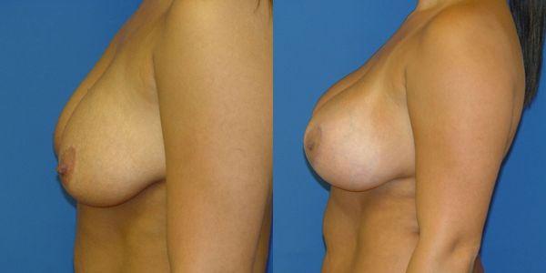 Breast Augmentation Before and After Patient 129