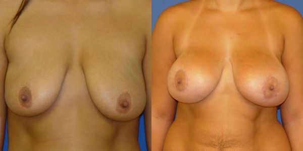 Breast Augmentation Before and After Patient 129 3