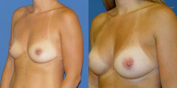 Breast Augmentation Before and After Patient 130 2