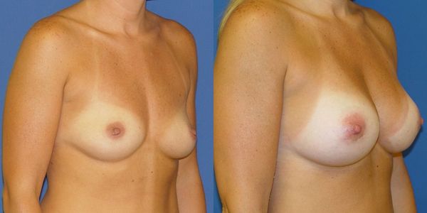 Breast Augmentation Before and After Patient 130
