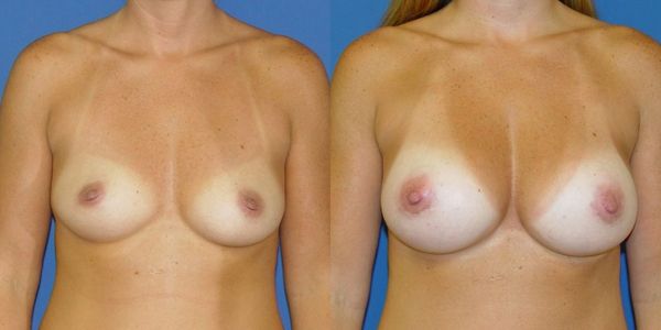 Breast Augmentation Before and After Patient 130 4