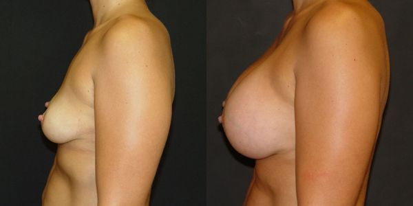 Breast Augmentation Before and After Patient 131