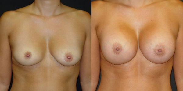 Breast Augmentation Before and After Patient 131 3