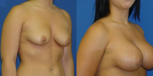 Breast Augmentation Before and After Patient 132 3
