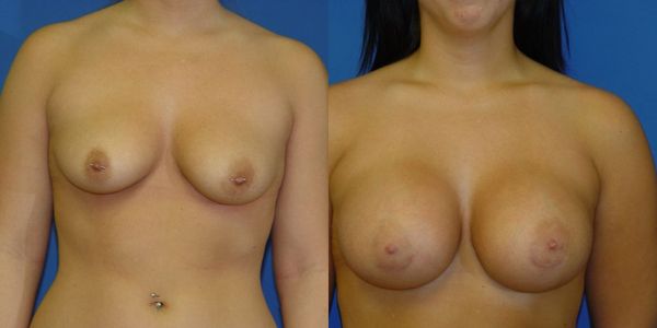 Breast Augmentation Before and After Patient 132