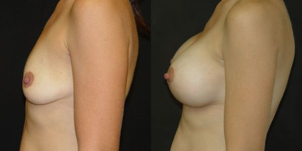 Breast Augmentation Before and After Patient 133 3