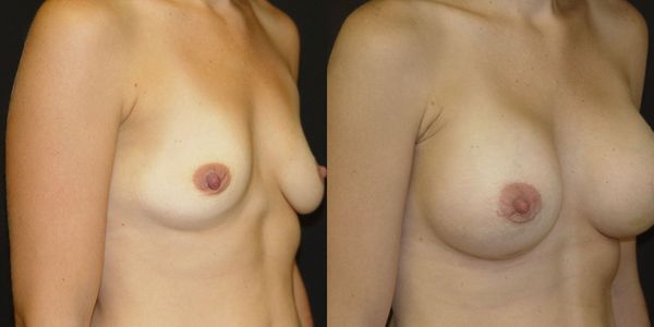 Breast Augmentation Before and After Patient 133 2