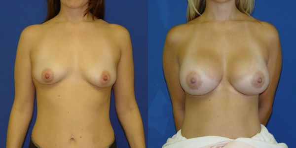 Breast Augmentation Before and After Patient 134