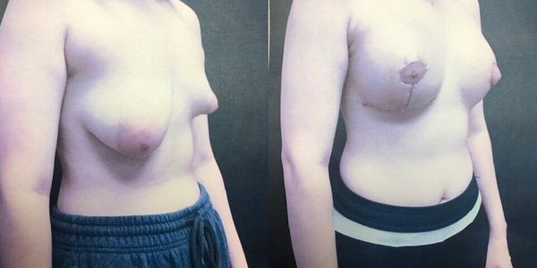 Breast Augmentation Before and After Patient 137 2