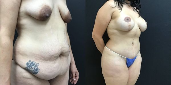 Breast Augmentation Before and After Patient 163 4