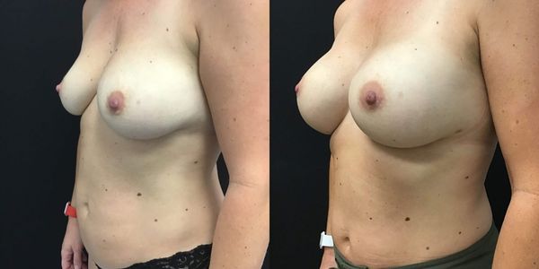 Breast Augmentation Before and After Patient 166 2