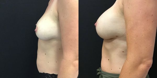 Breast Augmentation Before and After Patient 166 1