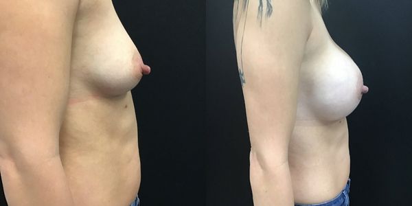 Breast Augmentation Before and After Patient 170 2